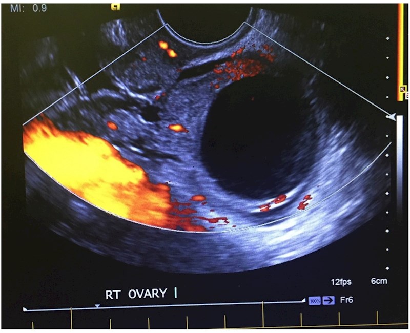 Pelvic ultrasounds referred from the emergency department: agreement between sonographer findings and radiologist reports